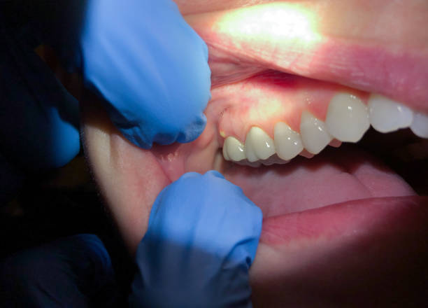 Best Emergency Tooth Extraction in Choccolocco, AL